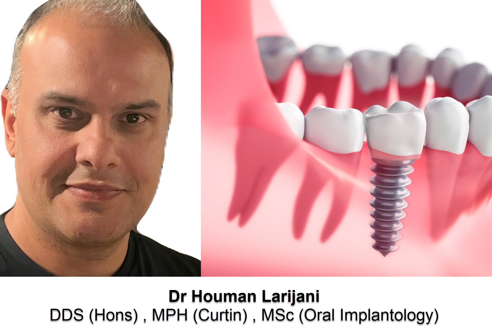dental_implant_surgery